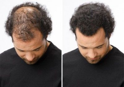 men hair growth